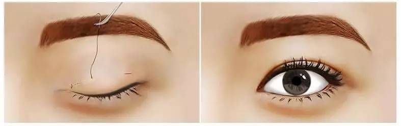 How much is japan's eyelid cut