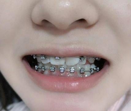 牙齿矫正的原理