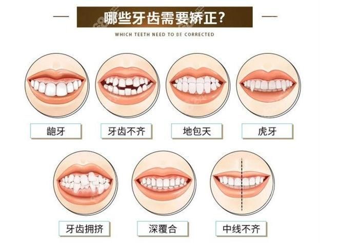 牙齿矫正的原理