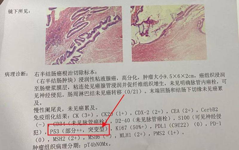 Carcinocyte fragmentation