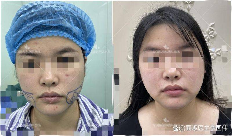 大腿吸脂价格多少钱