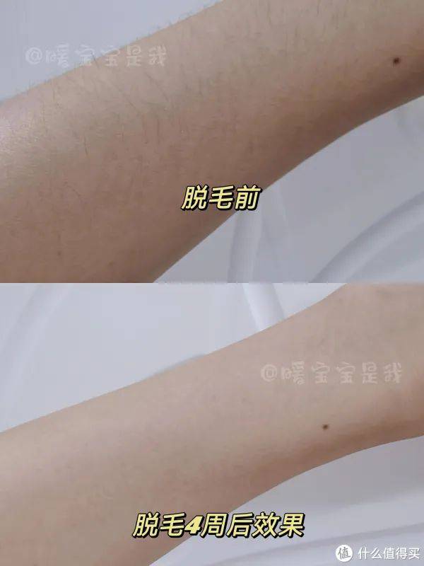 小腿脱毛费用多少