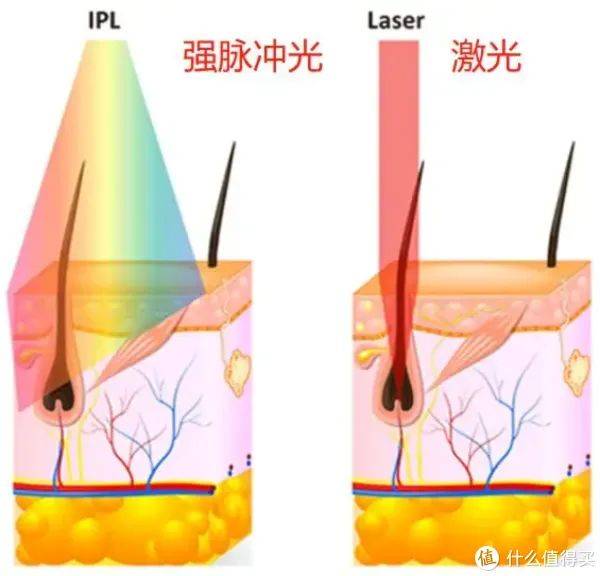 小腿脱毛费用多少