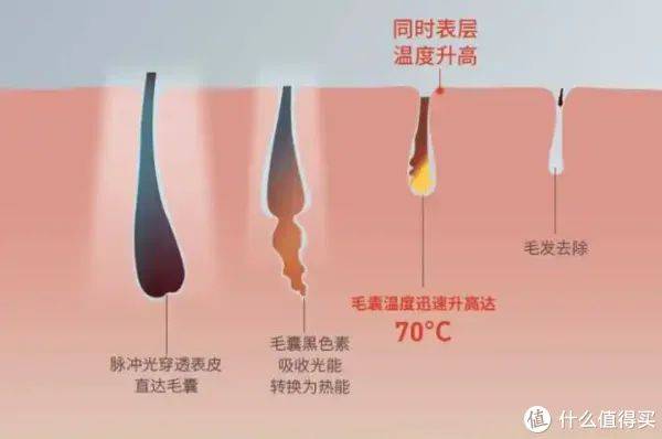 小腿脱毛费用多少