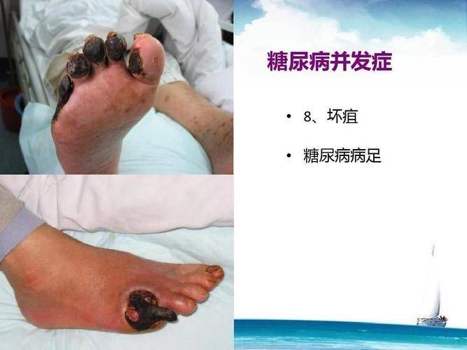 糖尿病用药特点