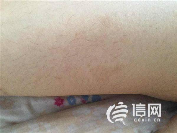 小腿脱毛费用多少