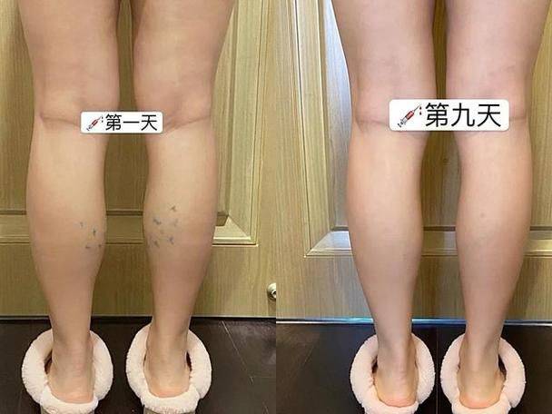 美国瘦脸针保妥适进价