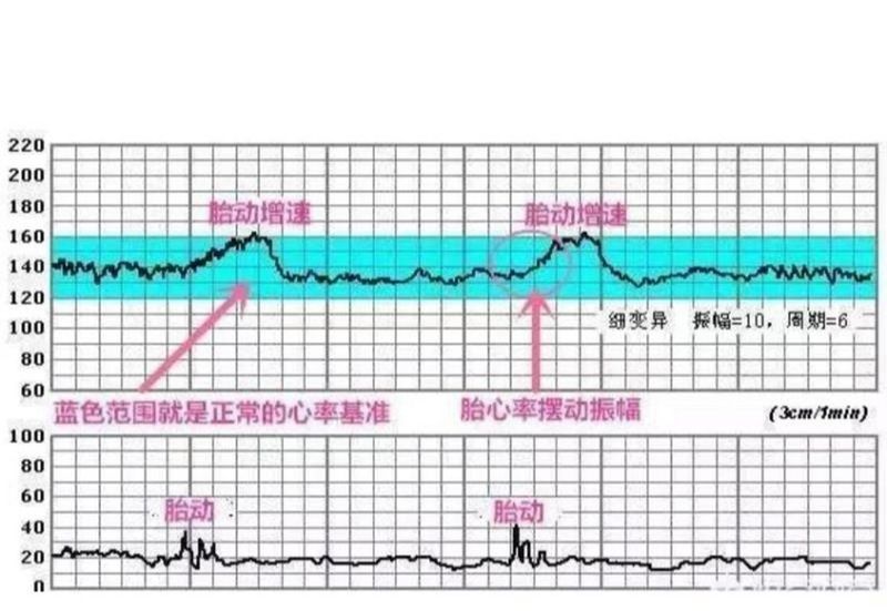 监测胎心多少钱