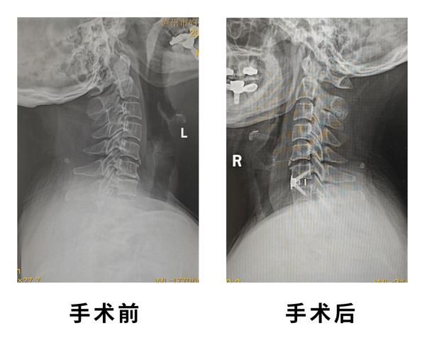 二次植骨手术费多少钱