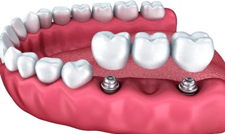 专业种植牙费用
