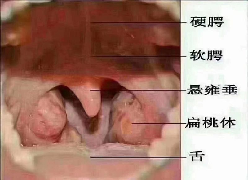 上呼吸道阻塞特点
