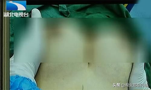 自体丰胸大概多少钱