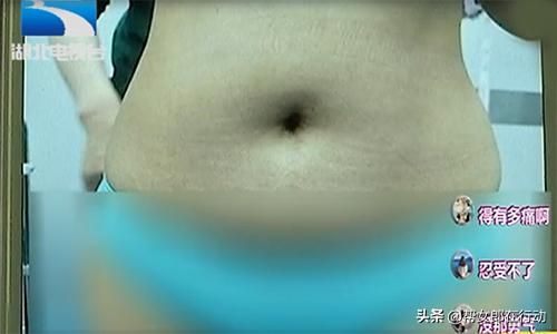 自体丰胸大概多少钱