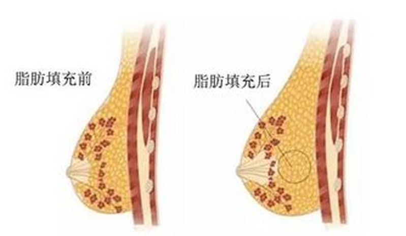 自体丰胸大概多少钱