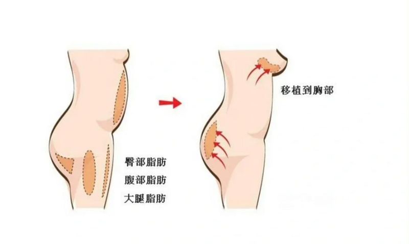 自体丰胸大概多少钱