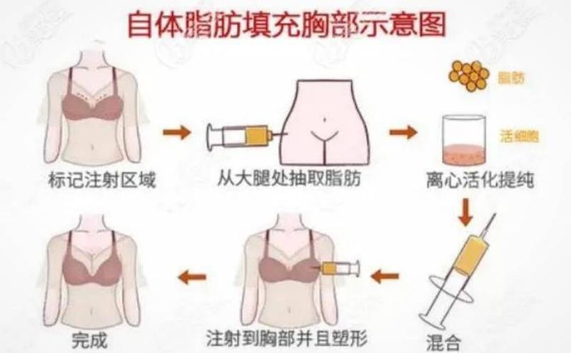 自体丰胸大概多少钱