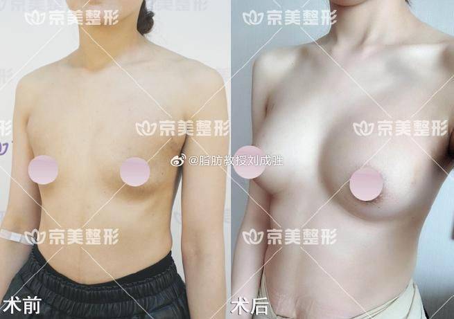 自体丰胸大概多少钱