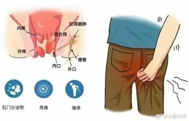 肛瘘挂线手术的原理