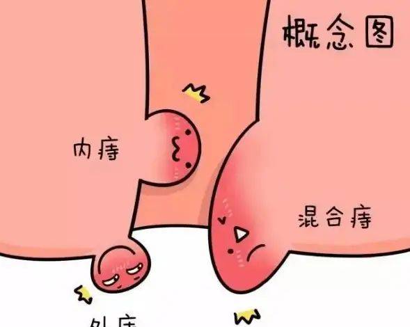 肛瘘挂线手术的原理