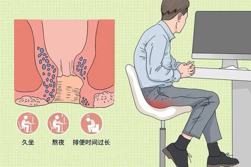 肛瘘挂线手术的原理