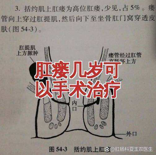肛瘘挂线手术的原理