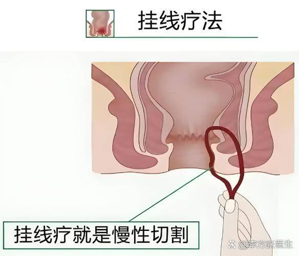 肛瘘挂线手术的原理