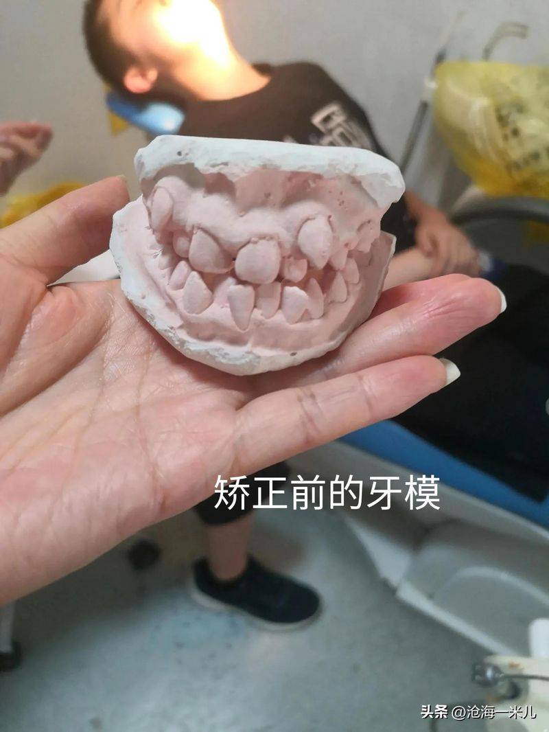 矫正牙齿的保持器多少钱
