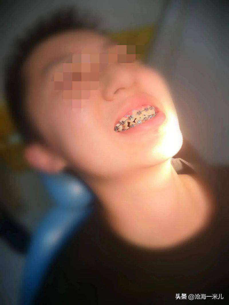 矫正牙齿的保持器多少钱
