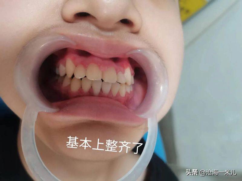矫正牙齿的保持器多少钱