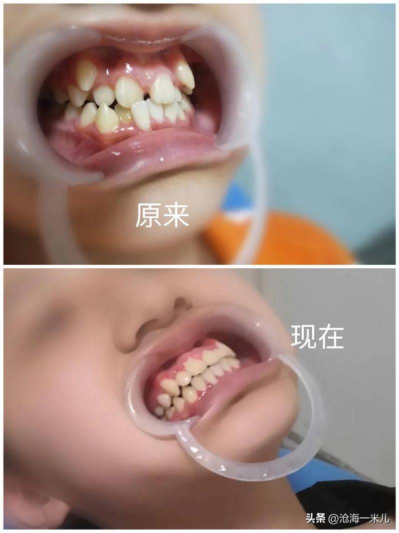 矫正牙齿的保持器多少钱