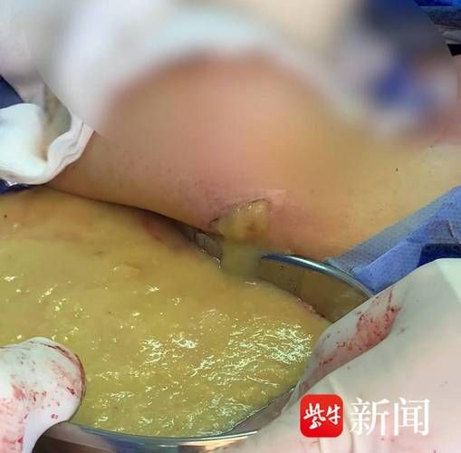 注射丰胸一般多少钱