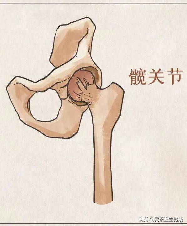 髋关节置换术多少钱