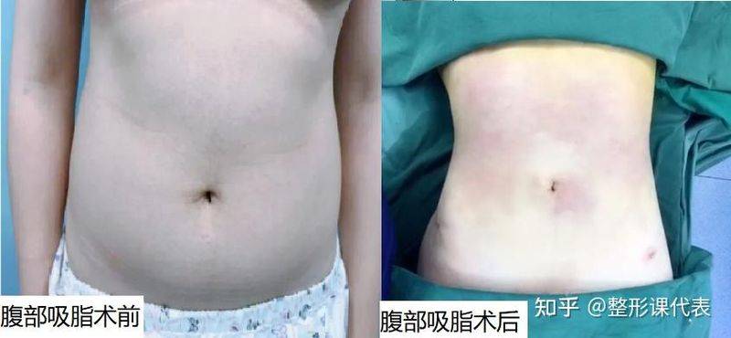 吸脂脸部手术一般多少钱