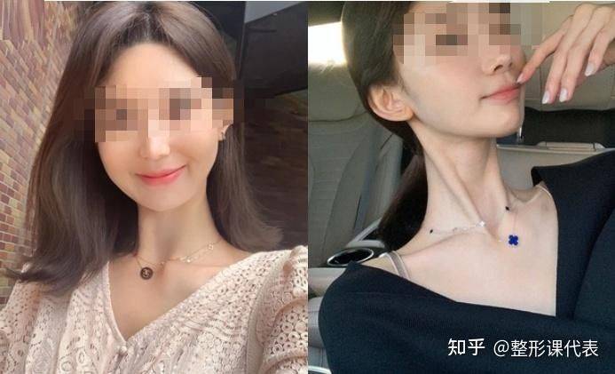 吸脂脸部手术一般多少钱