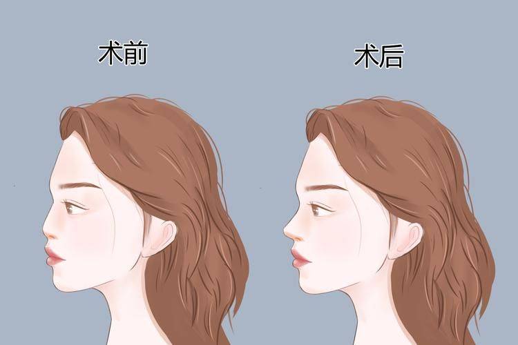 隆鼻打针多少钱