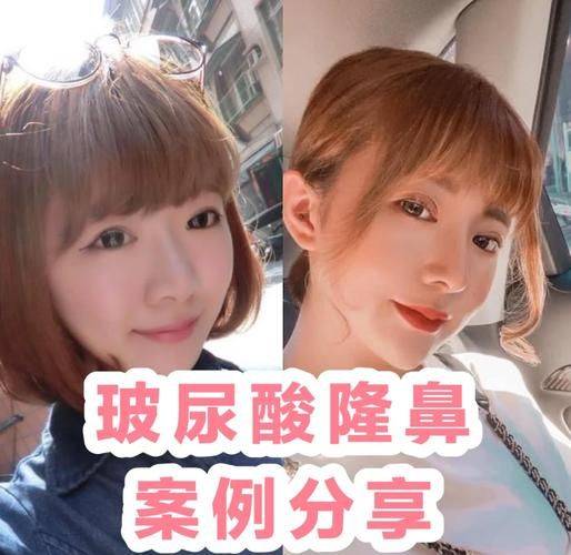 隆鼻打针多少钱