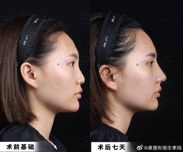 隆鼻打针多少钱