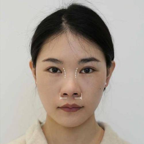 隆鼻打针多少钱