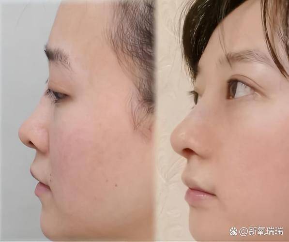 隆鼻打针多少钱