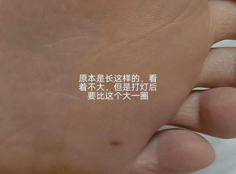 同济医院手术去黑痣多少钱
