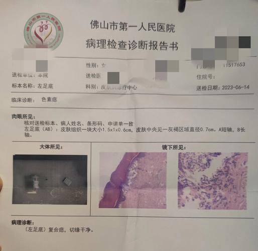 同济医院手术去黑痣多少钱