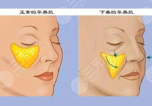 国产玻尿酸多少钱一支