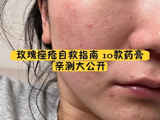 脸部痤疮治疗多少钱