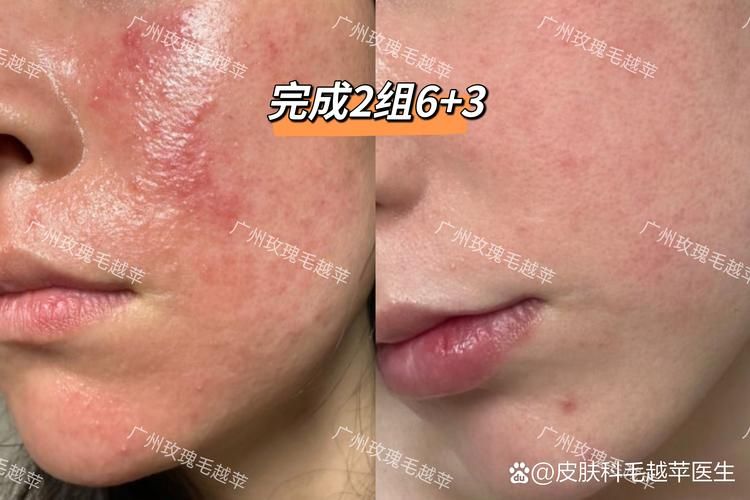 脸部痤疮治疗多少钱