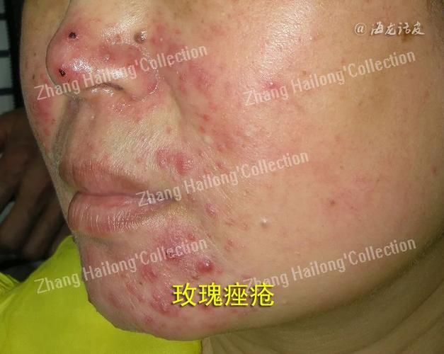 脸部痤疮治疗多少钱