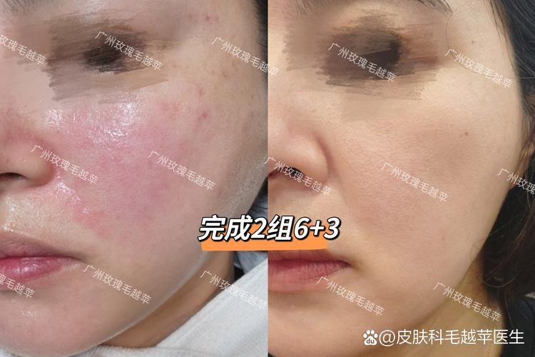 脸部痤疮治疗多少钱