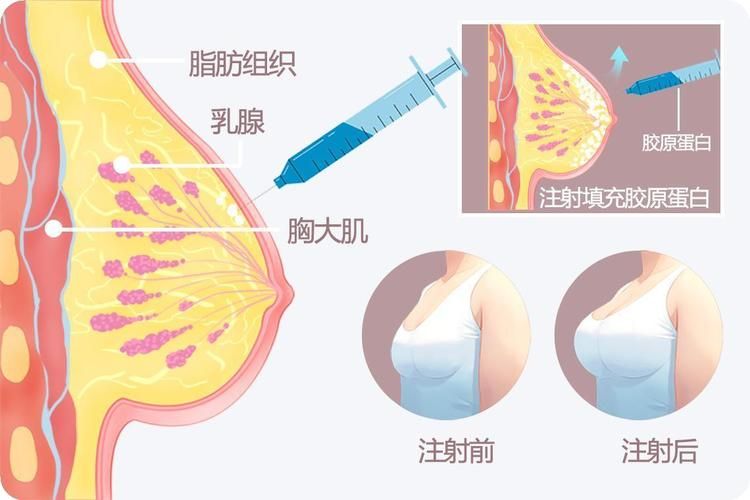 丰胸大概要多少钱 医院
