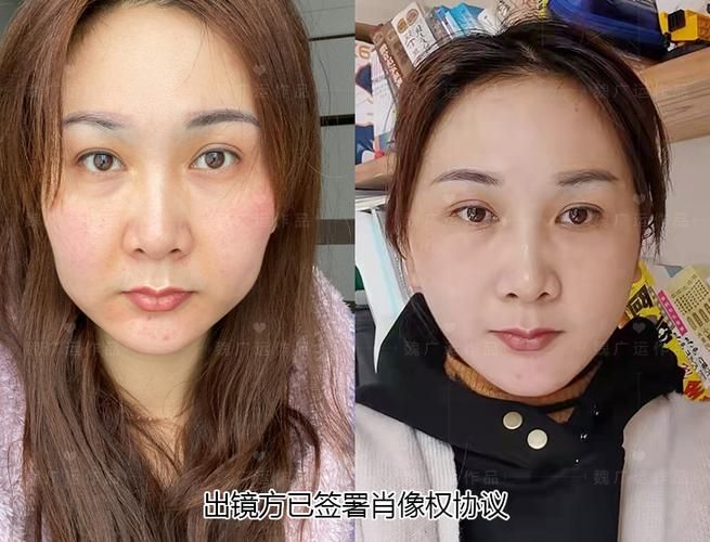 最简单瘦脸方法