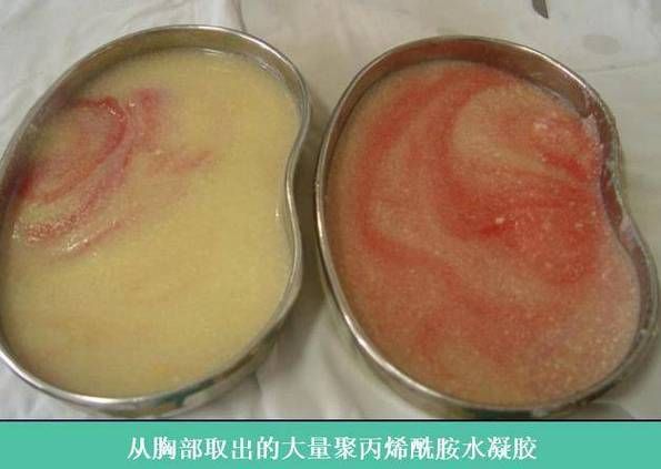 丰胸大概要多少钱 医院