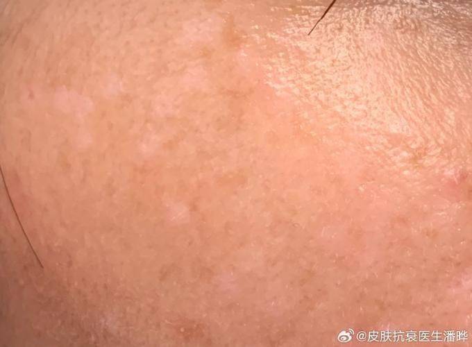 调q祛斑多少钱一次